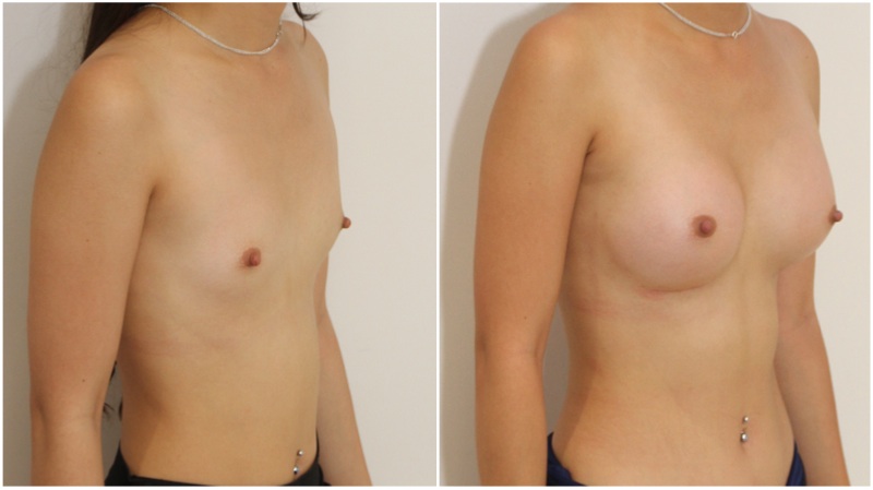 Early 20s, 255g anatomical, dual plane 2-3 placement.