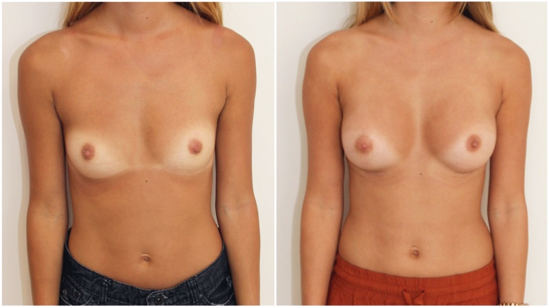 Subtle-style enhancement by Dr M using 245g moderate profile anatomics