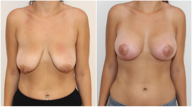 Breast lift/reshape + simultaneous augmentation with 330cc Round Style Implants