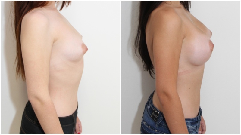Grade 1 Tuberous style breasts, reshaped and augmented with 330cc anatomics