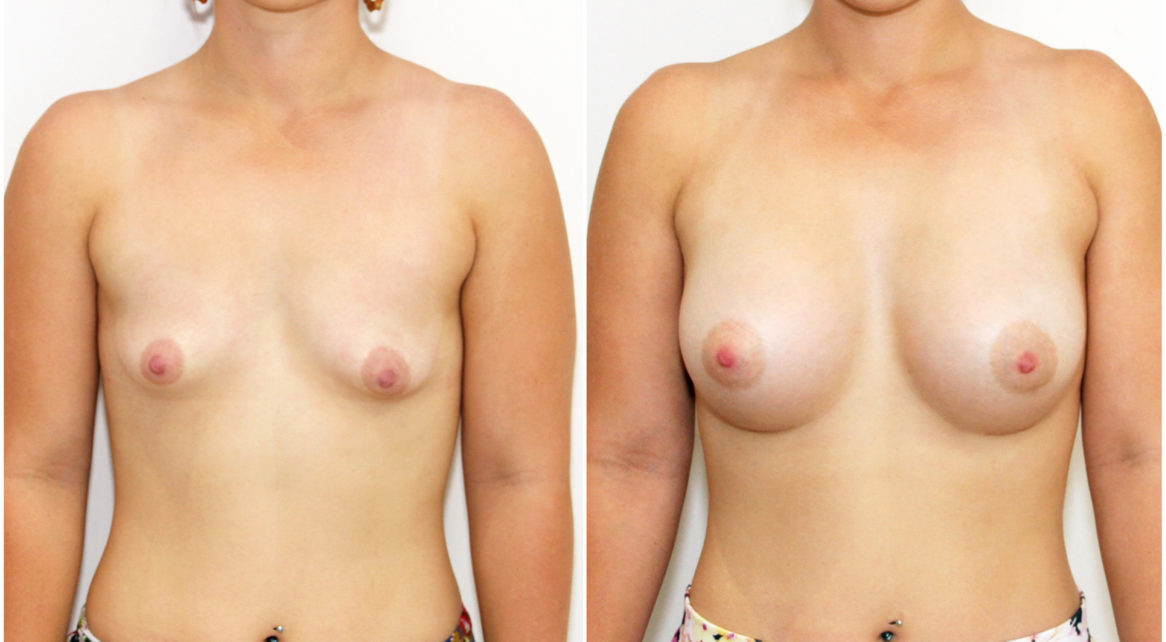 Grade 1 tuberous breasts can be corrected without periareolar incisions like shown here (420cc anatomics).