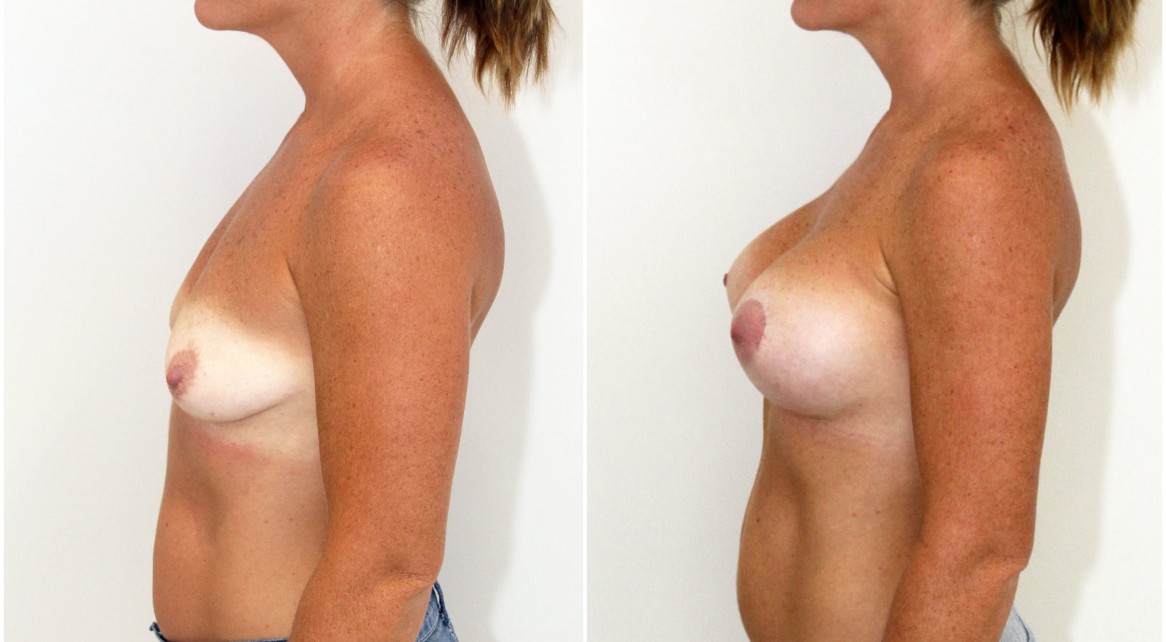 30s, early deflation correct with 440cc anatomics, memory gel with crescentic peri-areolar lift on left side.