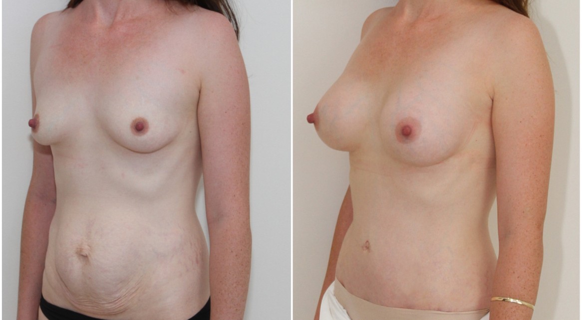 Breast augmentation and shaping with 250g breast anatomics, full tummy tuck to sculpt the abdomen.