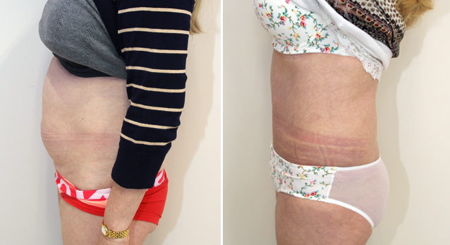 Full tummy tuck to correct abdominal wall laxity and muscle weakness