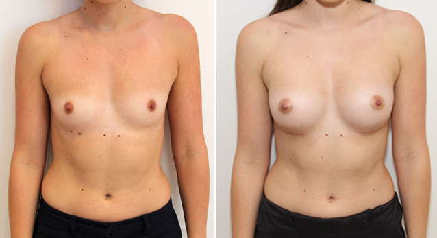 Subtle enhancement with 270g anatomicals, dual plane positioned.