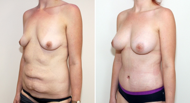 20s, tummy tuck used to tighten the muscles of the abdomen and remove excess skin post weight loss. A breast augmentation with 420g anatomical implants has also been performed.