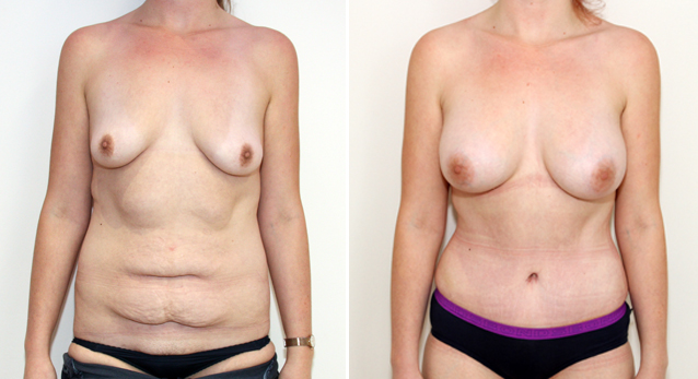 20s, tummy tuck used to tighten the muscles of the abdomen and remove excess skin post weight loss. A breast augmentation with 420g anatomical implants has also been performed.