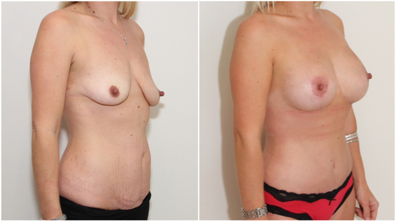 Mummy Makeover including breast lift/reshape + 325cc implants as well as muscle tightening tummy tuck to create a waistline.