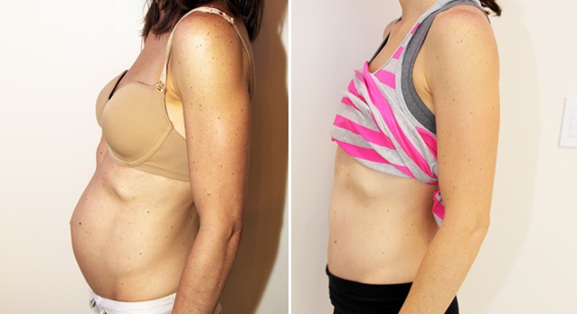 Severe muscle separation post pregnancy correct with full tummy tuck.