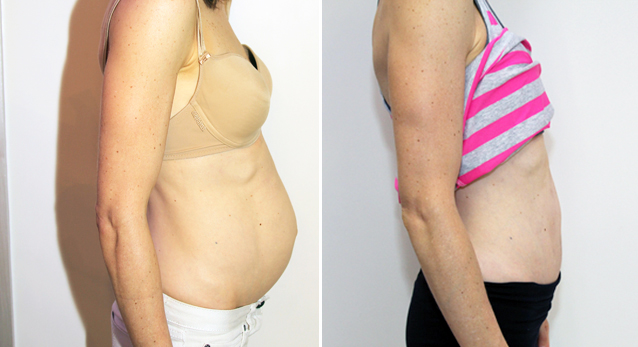 Severe muscle separation post pregnancy correct with full tummy tuck.