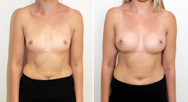 Subtle-style augmentation by Dr M with dual-plane positioned, 315g anatomical implants.