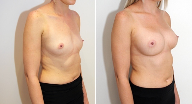 Subtle-style augmentation by Dr M with dual-plane positioned, 315g anatomical implants.