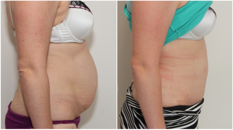 Muscle-tightening tummy tuck used here to correct abdominal muscle weakness and separation.