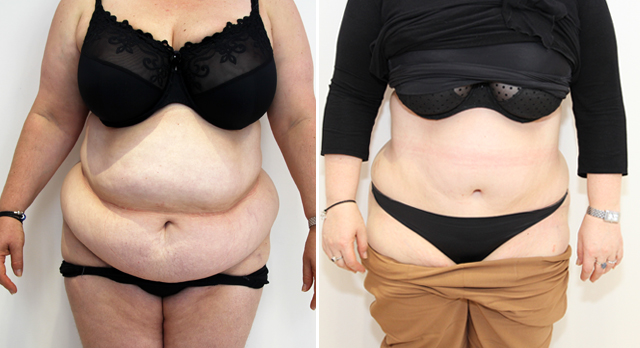 Extended tummy tuck to recontour the entire abdominal region.