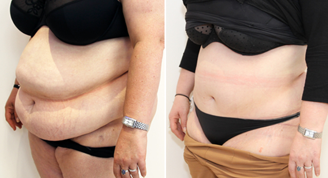 Extended tummy tuck to recontour the entire abdominal region.