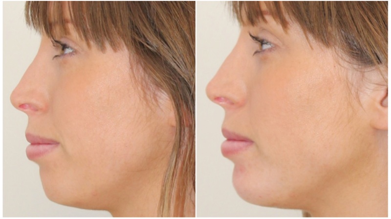 Volumising filler used to increase chin projection to enhance profile