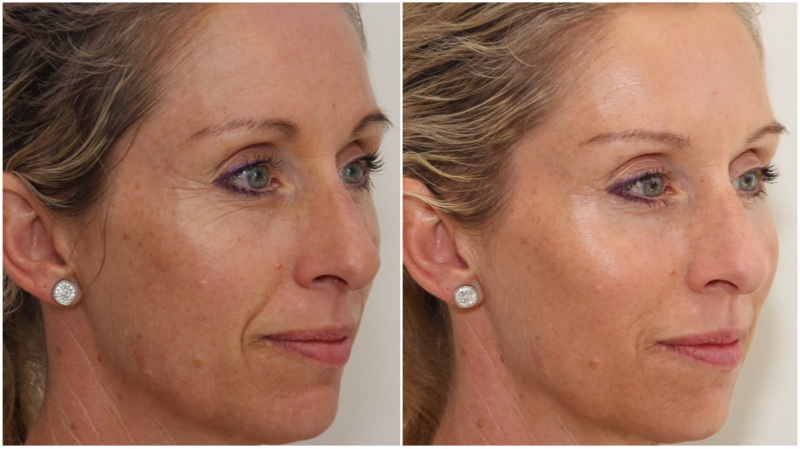 Volumising filler used to enhance cheeks, hydrating filler used to soften mouth lines and under eye hollowing. Anti-wrinkle injections have been used to soften lines on the forehead, frown and to achieve a brow lift