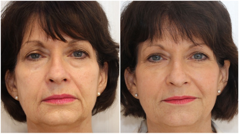 Volumising fillers used to soften ageing concerns in the mid and lower face regions