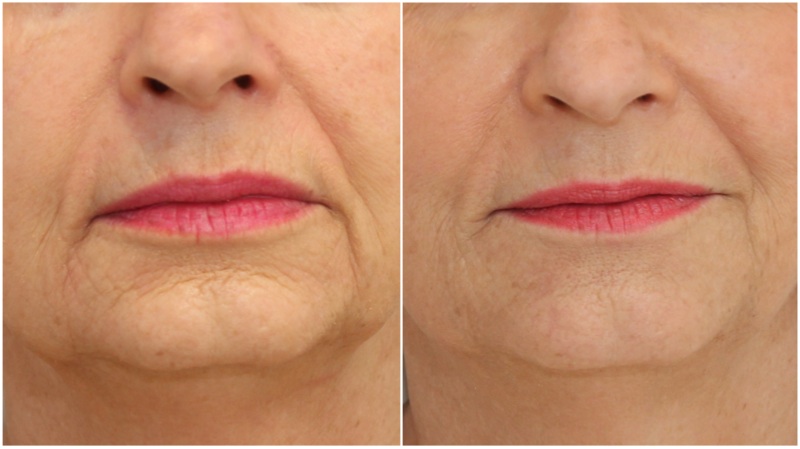 Hydrating dermal fillers used to soften marionette lines, smile lines and improve skin texture