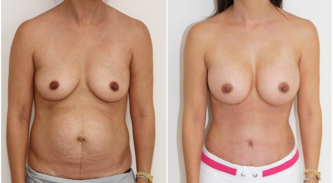Mummy makeover with a breast augmentation using 300cc mod plus profile implants complemented with a waist tightening, abdominal contouring tummy tuck.