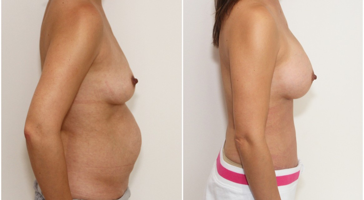 Mummy makeover with a breast augmentation using 300cc mod plus profile implants complemented with a waist tightening, abdominal contouring tummy tuck.
