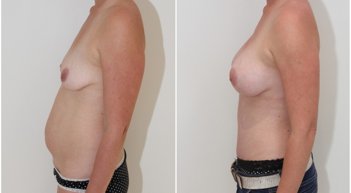 30s, mummy makeover with 375cc mod plus profile breast enhancement and full tummy tuck.