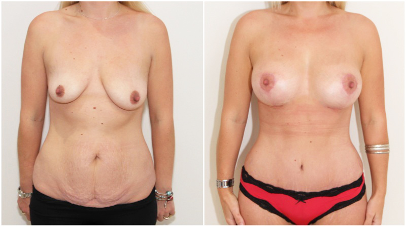 Mummy Makeover including breast lift/reshape + 325cc implants as well as muscle tightening tummy tuck to create a waistline.