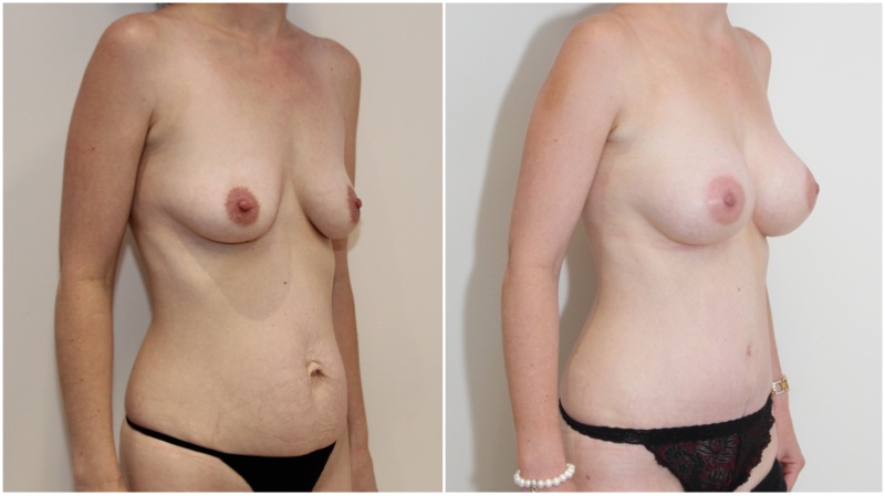 Mummy Makeover with full muscle-tightening, waist defining tummy tuck and breast enhancement.