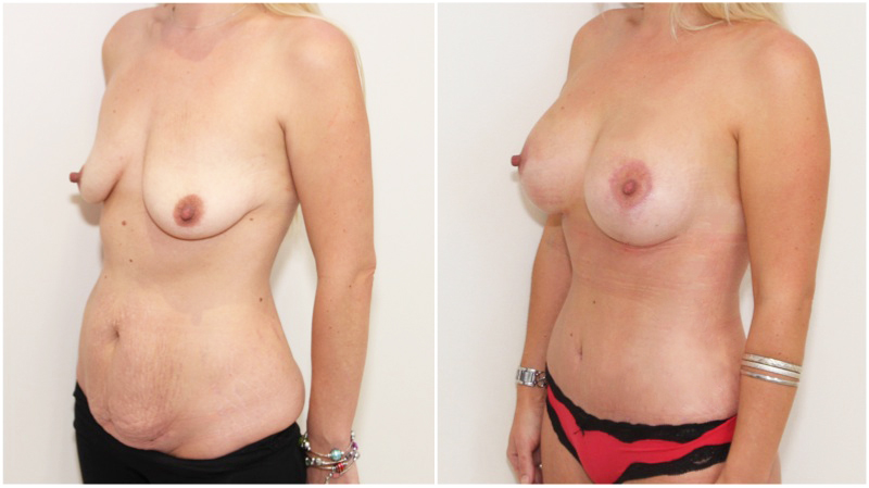 Mummy Makeover including breast lift/reshape + 325cc implants as well as muscle tightening tummy tuck to create a waistline.