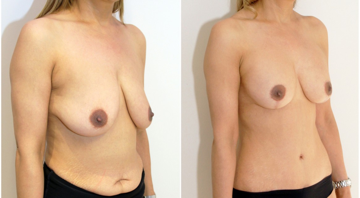 40s, children, waist creation and muscle/skin tightening, belly button repositioning and reshaping with a full tummy tuck. A breast lift has also been performed.