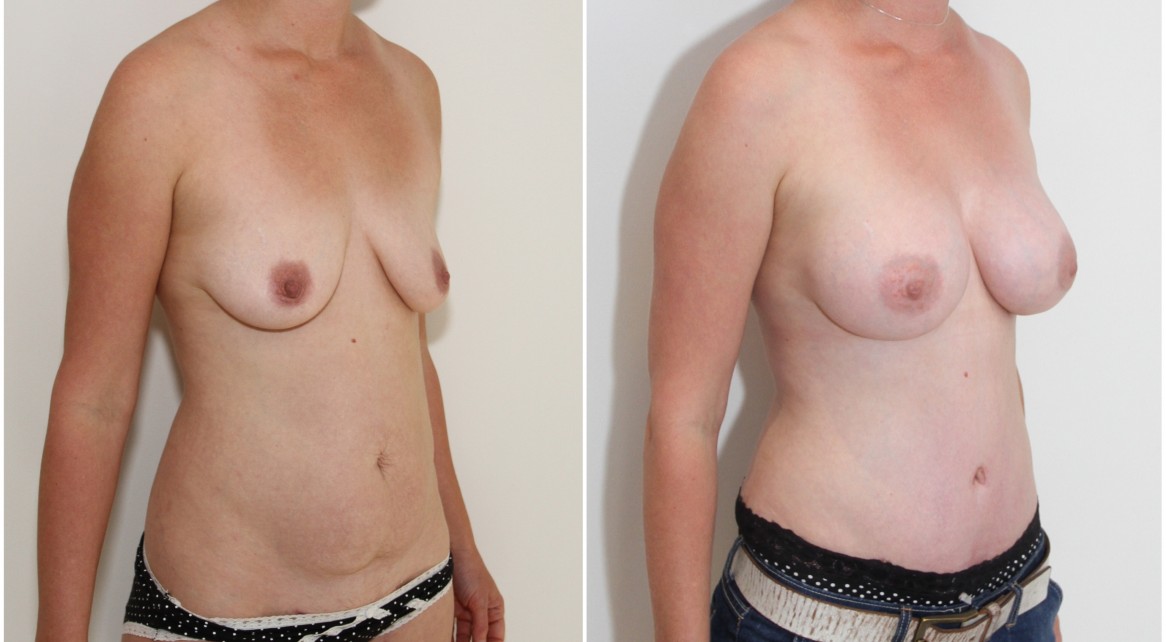 30s, mummy makeover with 375cc mod plus profile breast enhancement and full tummy tuck.