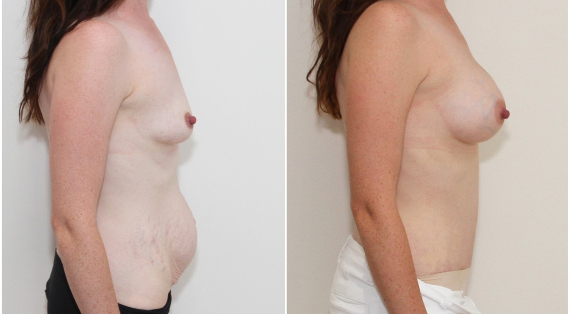 Breast augmentation and shaping with 250g breast anatomics, full tummy tuck to sculpt the abdomen.