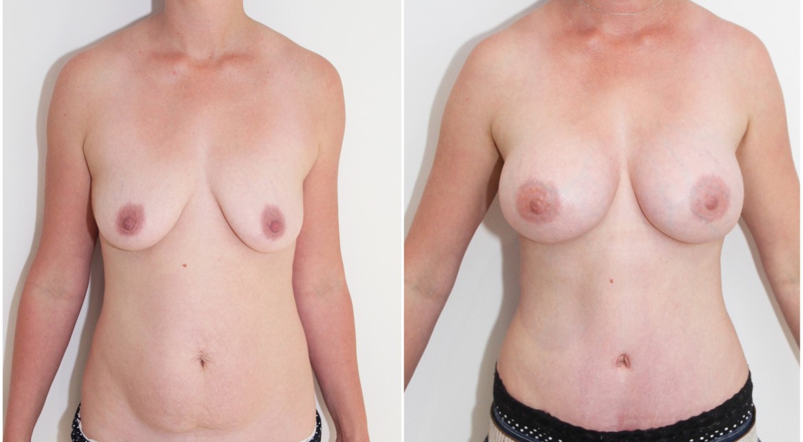 30s, mummy makeover with 375cc mod plus profile breast enhancement and full tummy tuck.