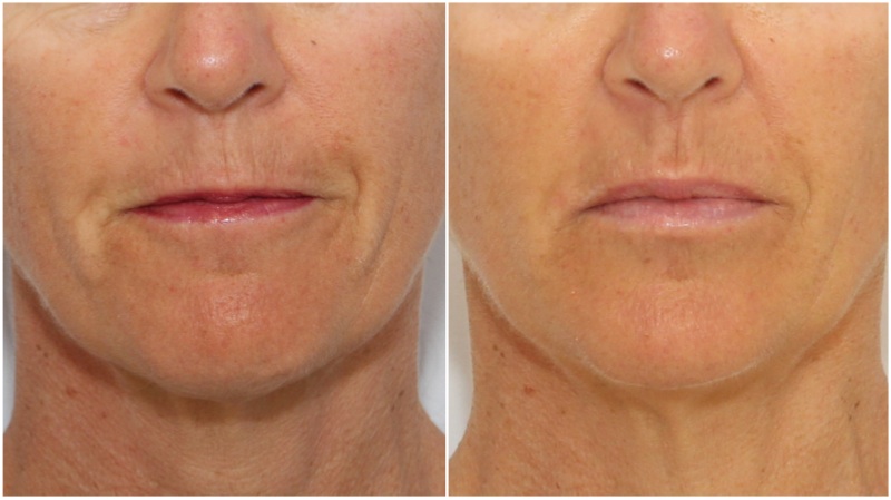 Lip enhancement and treatment of 'smokers lines' using a hydrating dermal fillers. Anti-wrinkle injections also used to further soften the lines