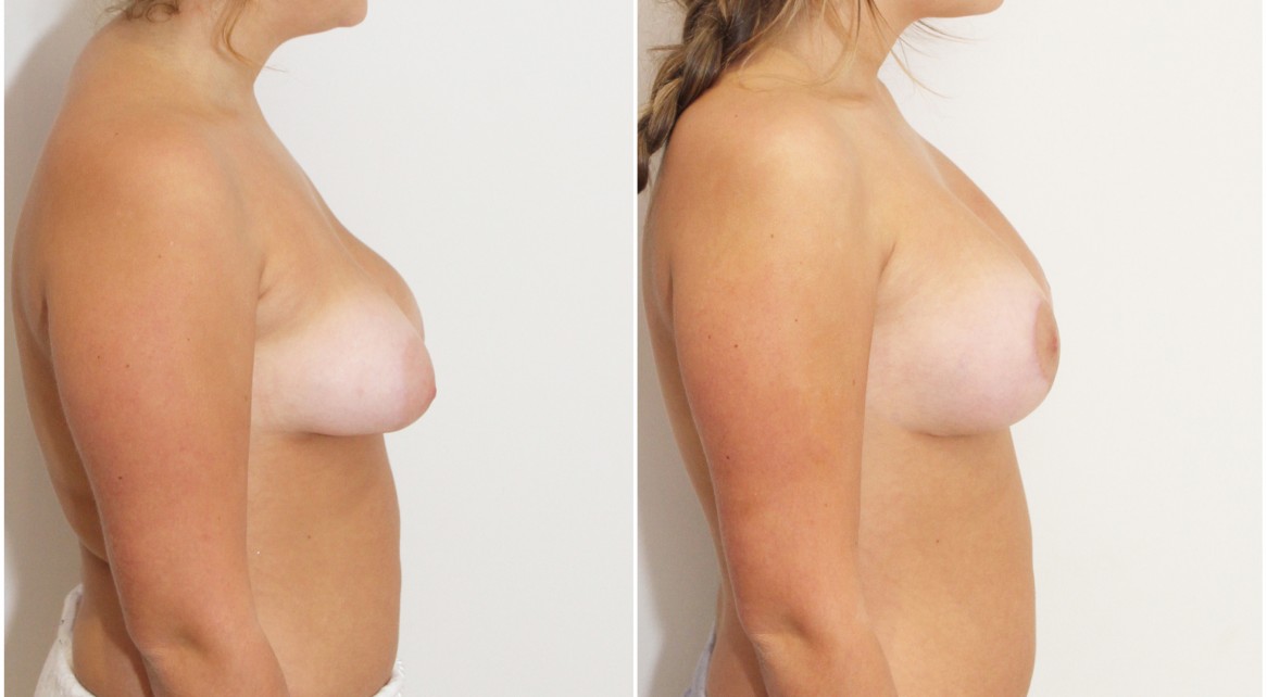 Early 20s, grade 2 tuberous breasts bilaterally, vertical reshape and lift with anatomical 280cc implants.