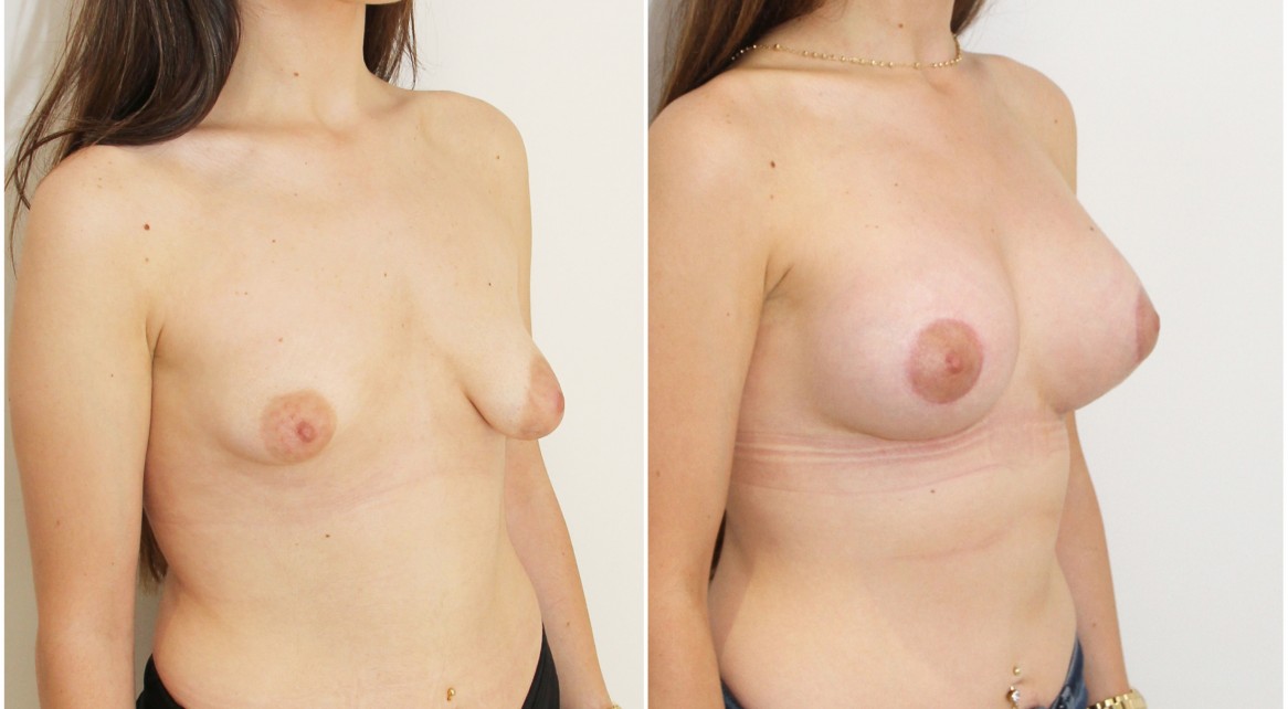 20s, bilateral tuberous breasts, periareolar mastopexy and lift with implants to reshape.