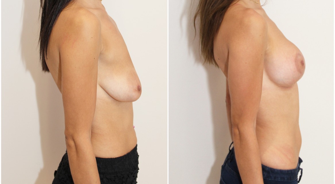 Breast lift + implants with subfascial placed, round style 325g implants.