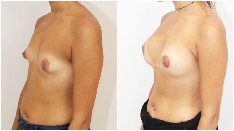 20s, tuberous breast shape corrected with subfascially placed 315g high profile anatomics.