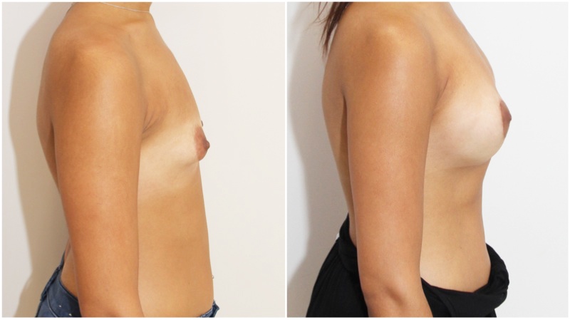 20s, tuberous breast shape corrected with subfascially placed 315g high profile anatomics.