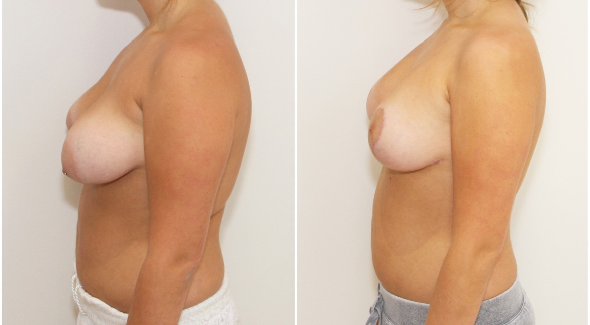 Early 20s, grade 2 tuberous breasts bilaterally, vertical reshape and lift with anatomical 280cc implants.