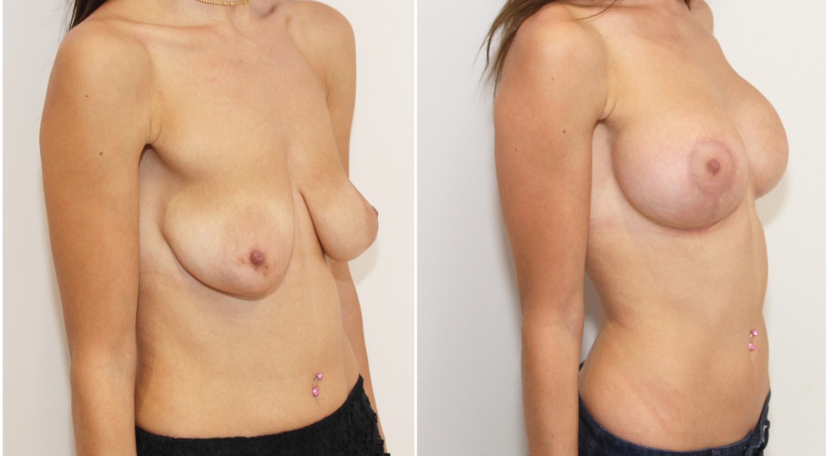 20s, tuberous breasts combined with ptosis (droop), correction with breast lift/reshape and 325g implants.