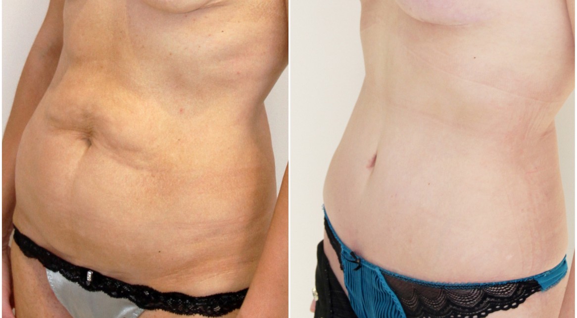 40s, children, muscle tightening/waist defining full tummy tuck.