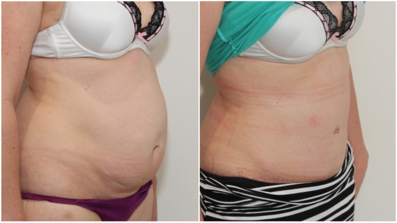Muscle-tightening tummy tuck used here to correct abdominal muscle weakness and separation.