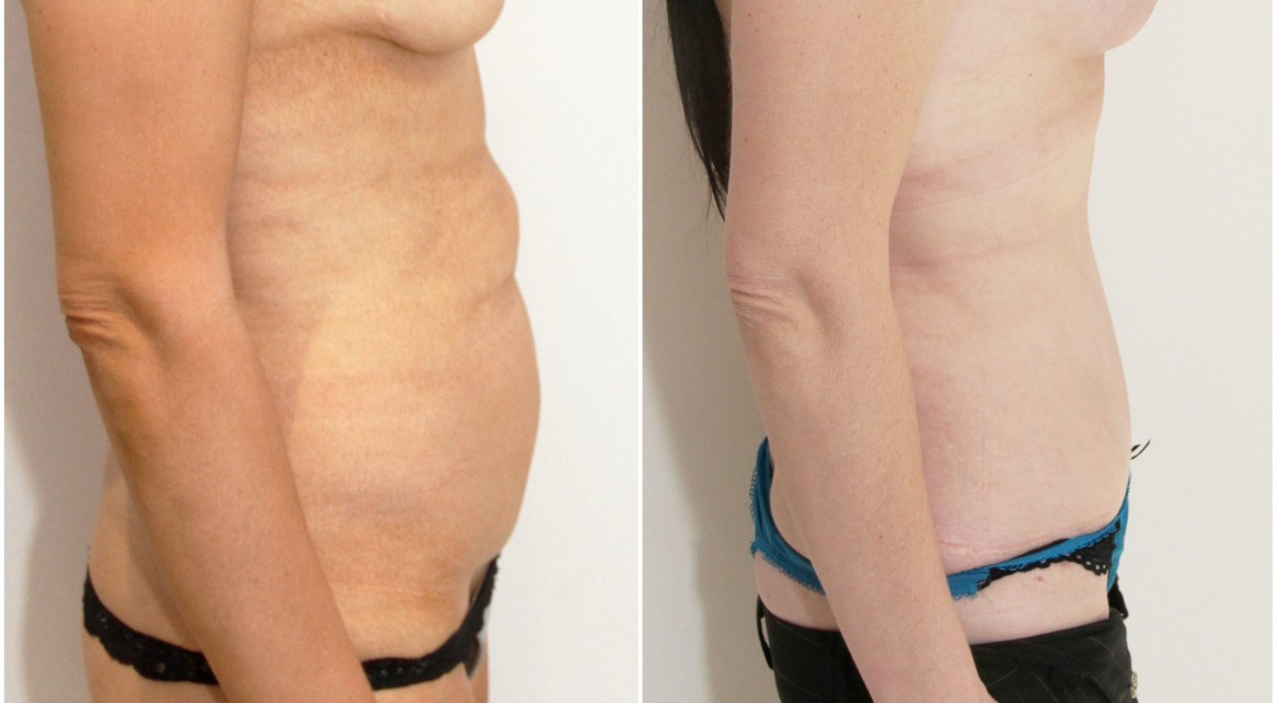 40s, children, muscle tightening/waist defining full tummy tuck.