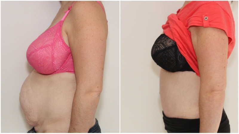 Full muscle-tightening tummy tuck used to remove all excess skin and tighten all abdominal musculature post multiple pregnancies in this mum.
