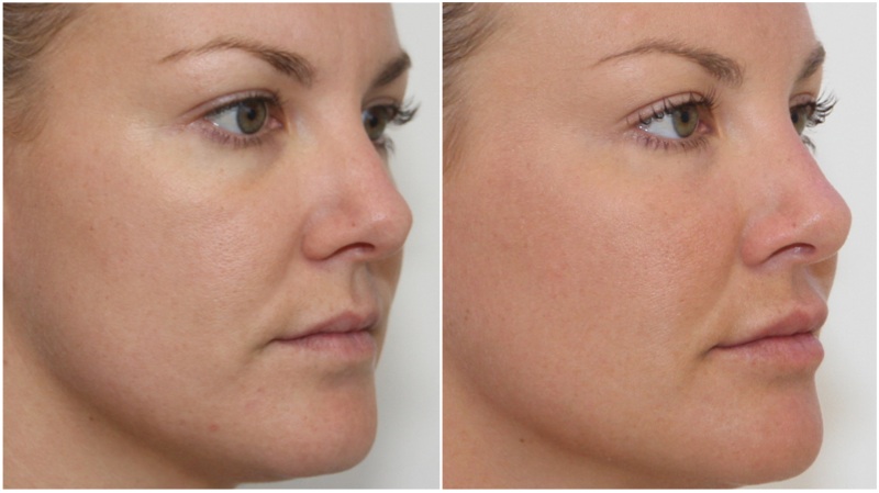 Cheek enhancement with volumising filler, hydrating filler used to soften under eye hollows and enhance lip projection. Anti-wrinkle injections used to lift the brow, and decrease wrinkling in the frown and crows-feet