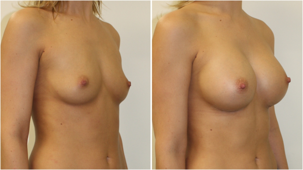 Enhanced style look created Dr Miroshnik using dual-plane positioned, high profile, 360g, memory gel style anatomical implants.
