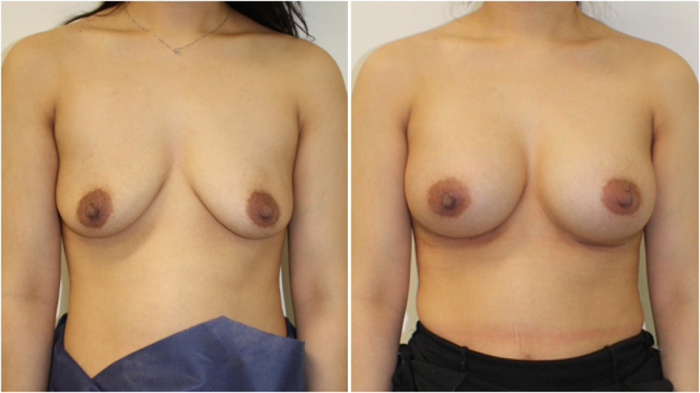 Breast augmentation by Dr Miroshnik to correct droop, using 325g anatomical implants