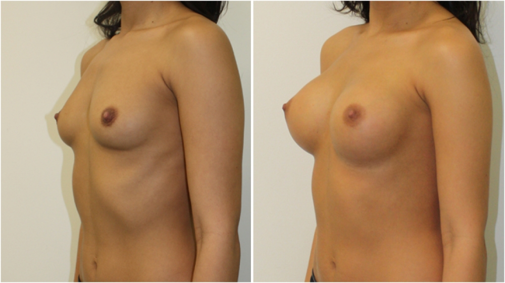 Enhanced style look created on a small framed patient with dual plane-positioned 215cc, high profile implants.
