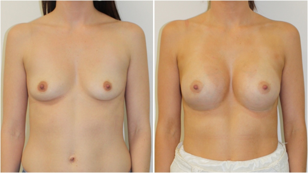 Enhanced-style look achieved by Dr Miroshnik with the use of 360g, extra high profile implants.